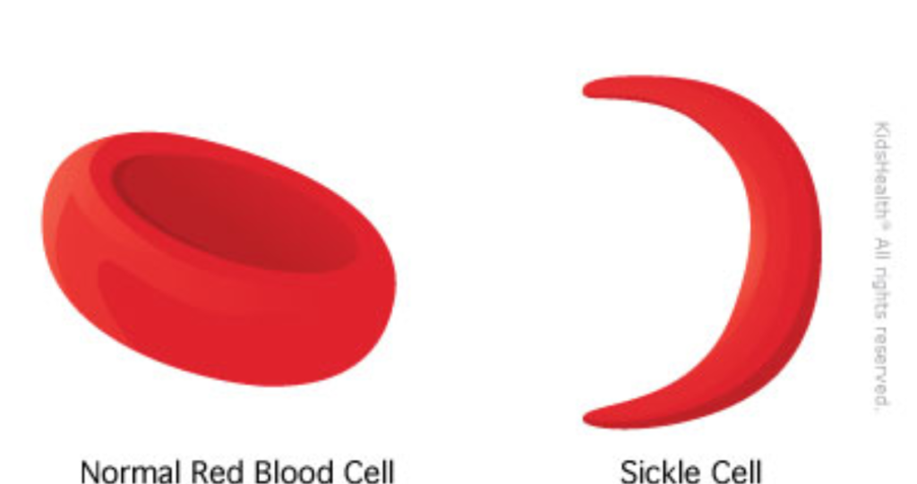 Sickle Cell
