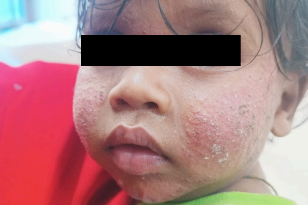 A close up image of a child's face with reddish skin on their cheeks and white dots across. A black line has been used to hide their identity.