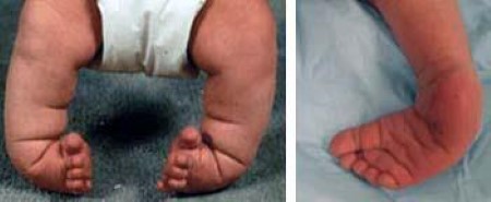 Two pictures. The one on the left has both foots turned inward towards each other. The picture on the right is of the right leg turned inward.